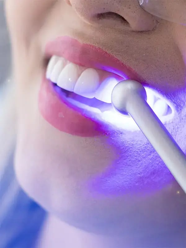 Limpieza y blanqueamiento dental