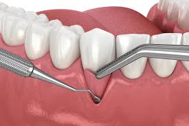 cirugía periodontal
