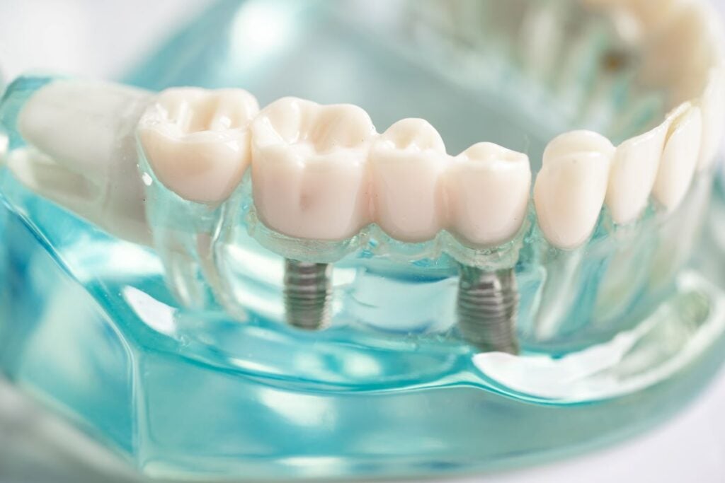 implantes dentales
